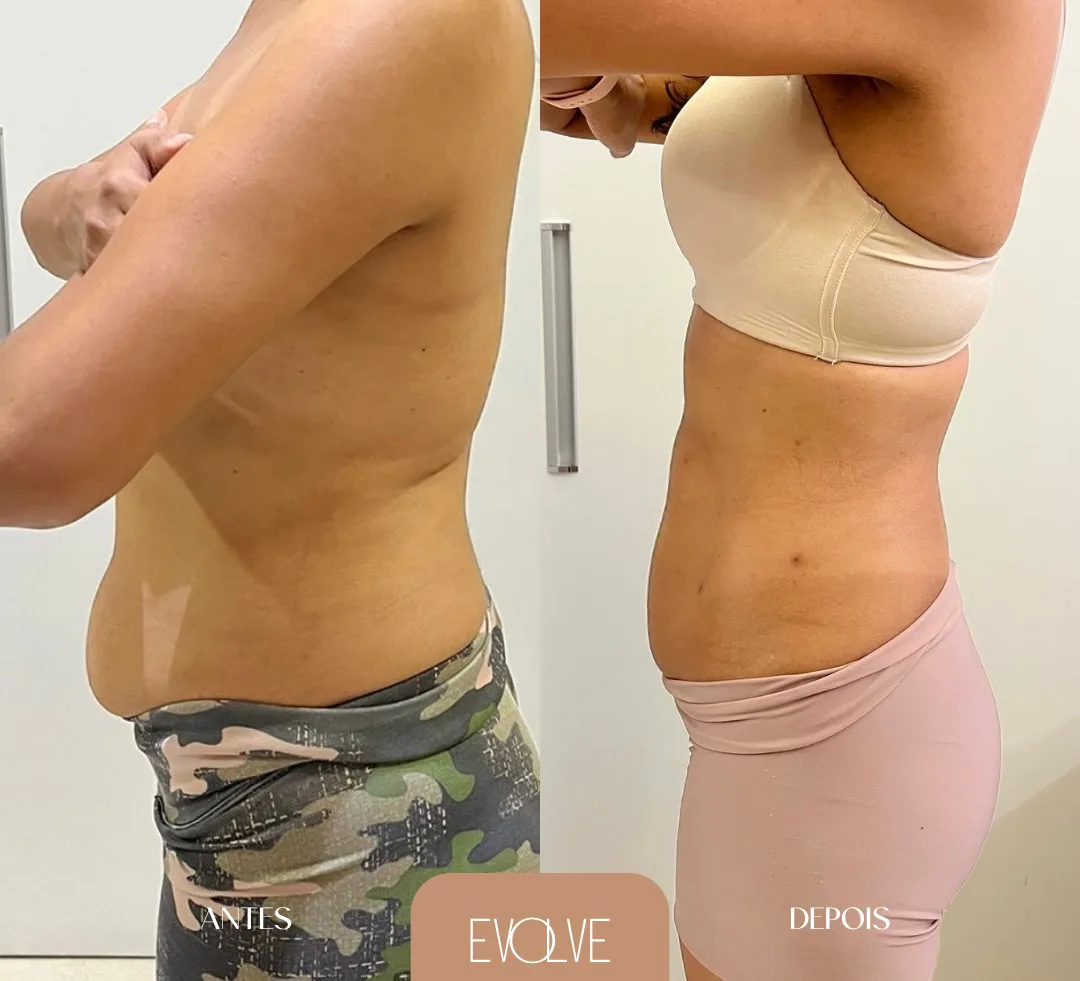 Resultado Endolaser - antes e depois