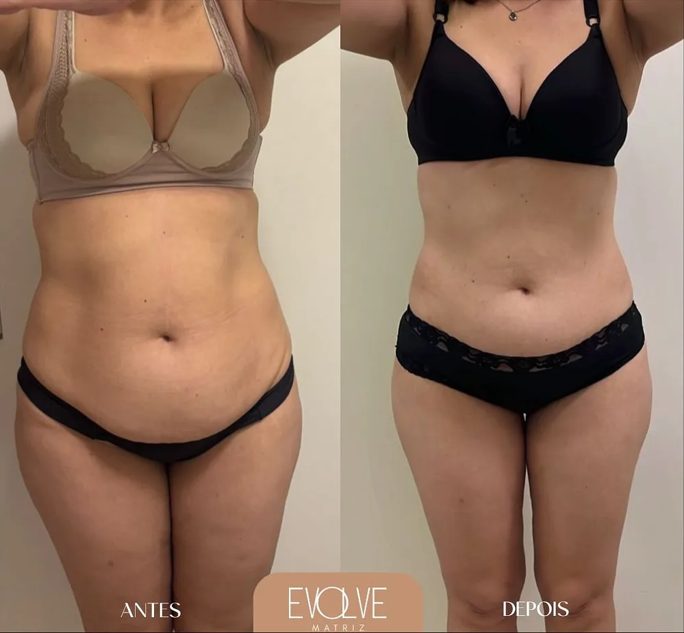 Resultado 3 meses após Endolaser