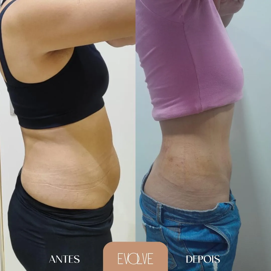 Antes e depois Endolaser